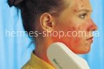 Аппарат для лечения акне (угри,прыщи) BioBeam Acne